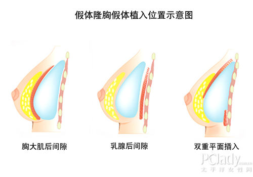 催眠隆胸? 2招医美丰胸术终极PK