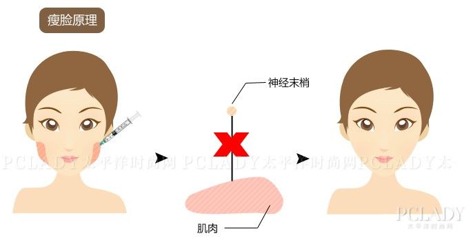 瘦脸针 我不是万能瘦脸神器