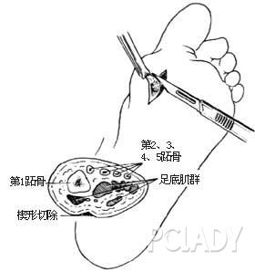 如何防治鸡眼