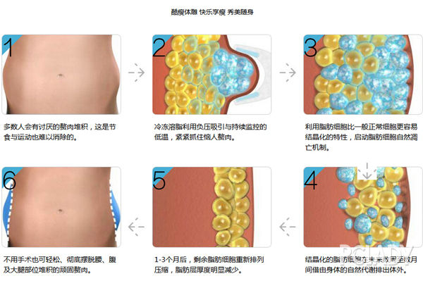 广州华美新品首发 酷瘦体雕冷冻溶脂