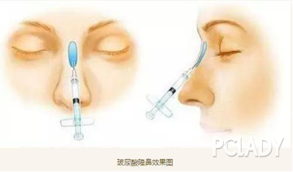 PCLADY专访田跃平主任 假体隆鼻，到底该用硅胶还是膨体?