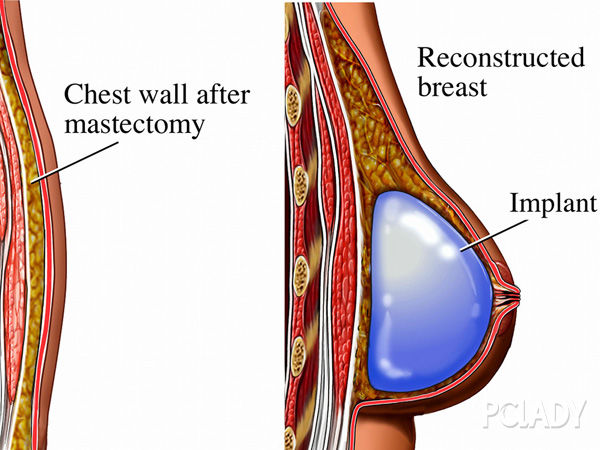 常见假体隆胸植入层次有哪些？如何选择植入层次？